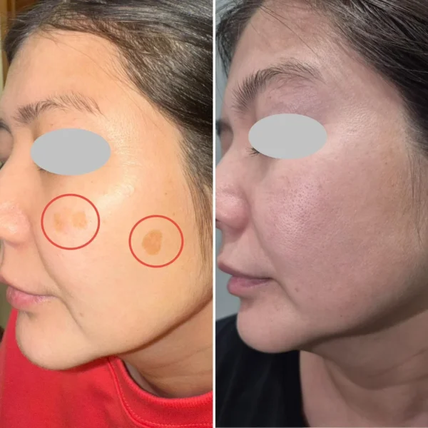 результаты процедуры на аппарате REX-Q AMI