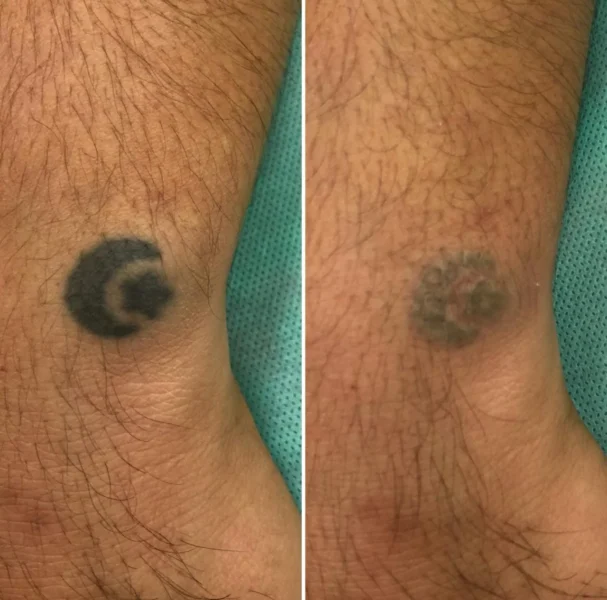 сведения татуировки алматы