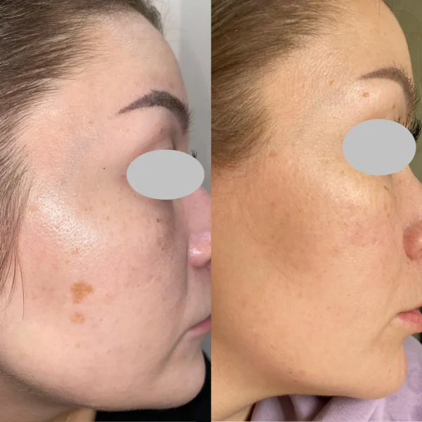 результаты процедуры на аппарате REX-Q AMI