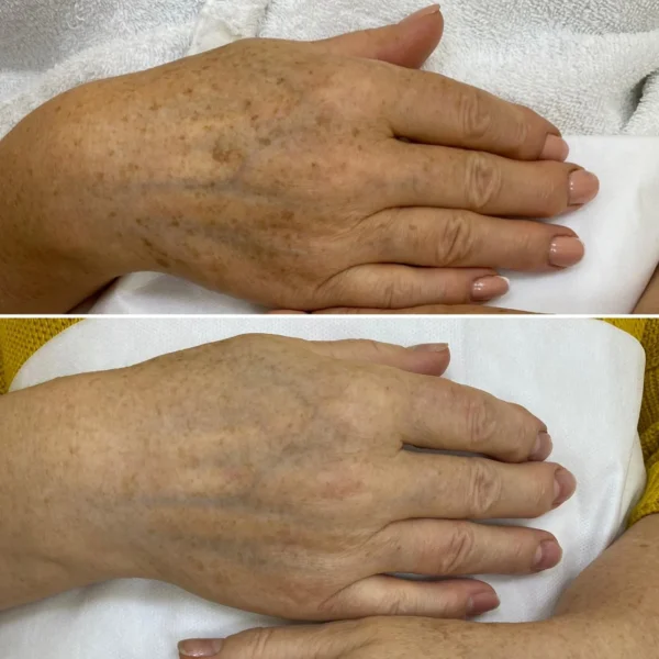 результаты процедуры на аппарате REX-Q AMI