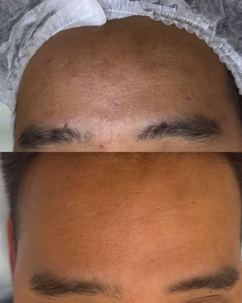 результат процедуры vivace